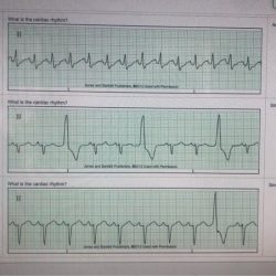 Relias dysrhythmia advanced test answers