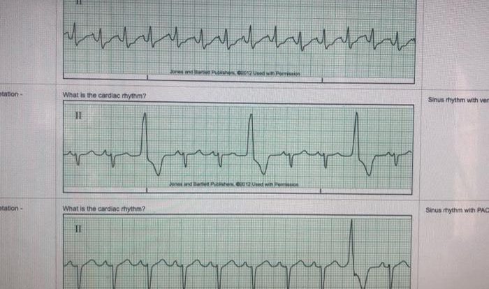 Relias dysrhythmia advanced test answers