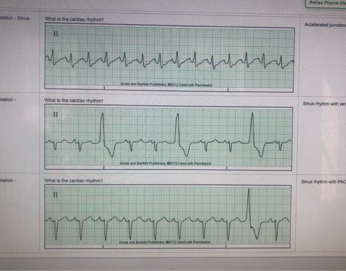 Relias dysrhythmia advanced test answers